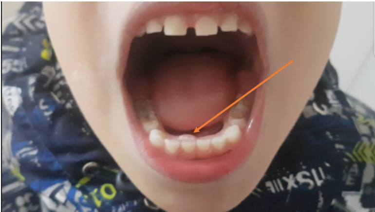 как вырвать зуб ребенку дома